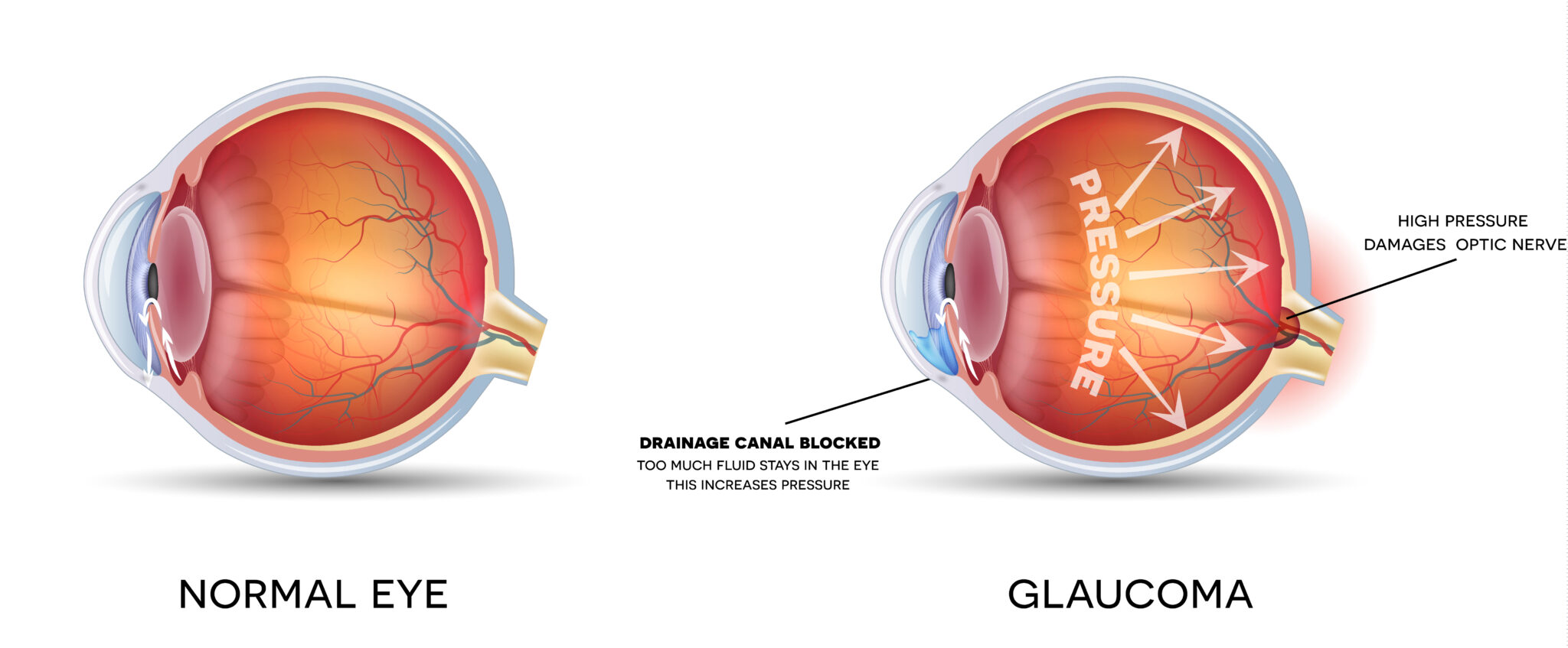 Glaucoma: A Clinician's Guide